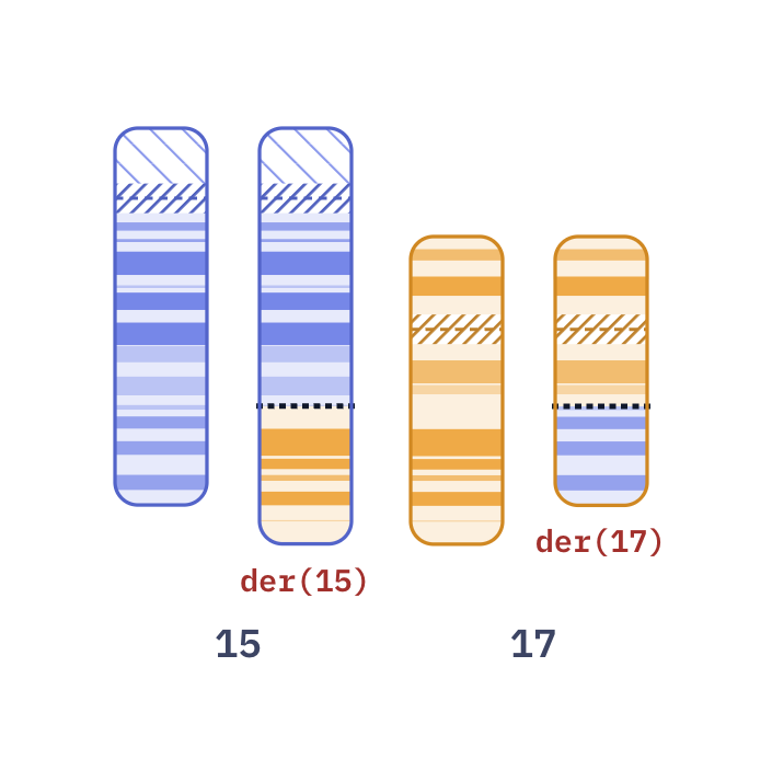 Karyotype of Acute promyelocytic leukemia t(15;17) (46,XY,t(15;17)(q24;q21))
