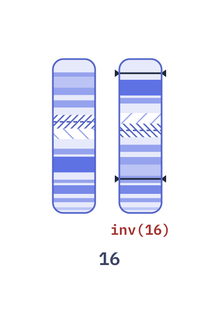 Karyotype of AML with inv(16) (46,XY,inv(16)(p13q22))