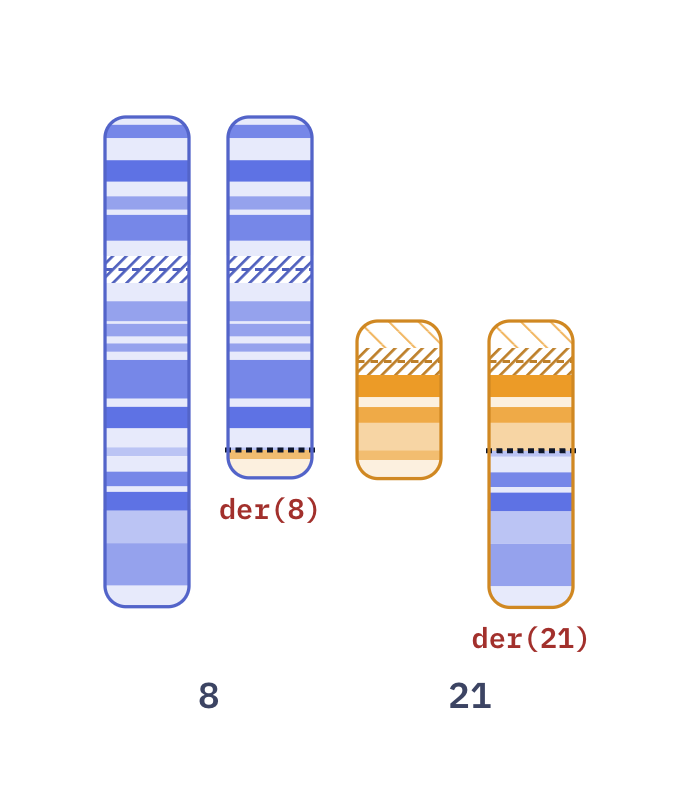 Karyotype of AML with t(8;21) (46,XX,t(8;21)(q22;q22))