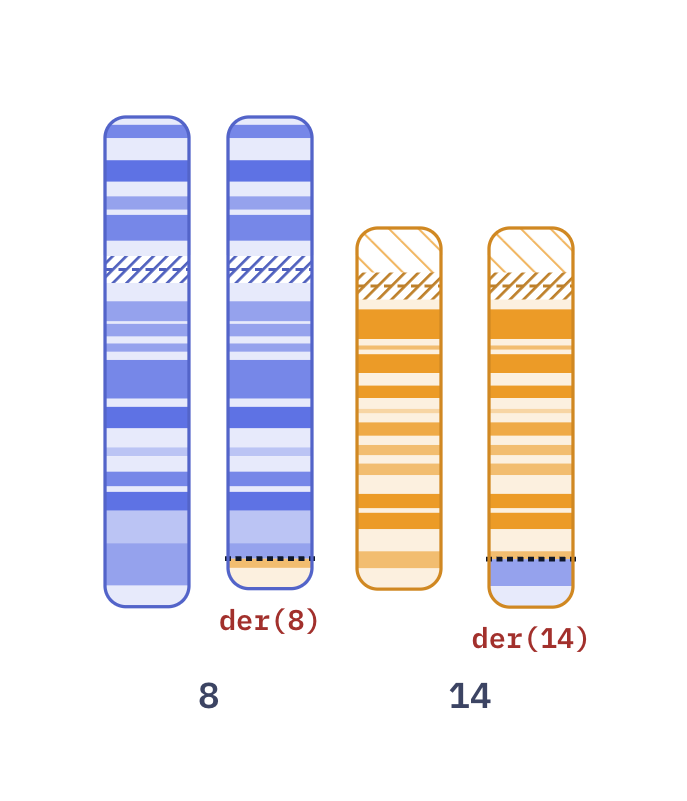 Karyotype of Burkitt lymphoma t(8;14) (46,XX,t(8;14)(q24;q32))