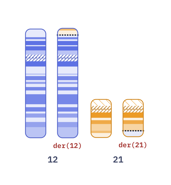 Karyotype of Childhood B-ALL t(12;21) (46,XX,t(12;21)(p13;q22))