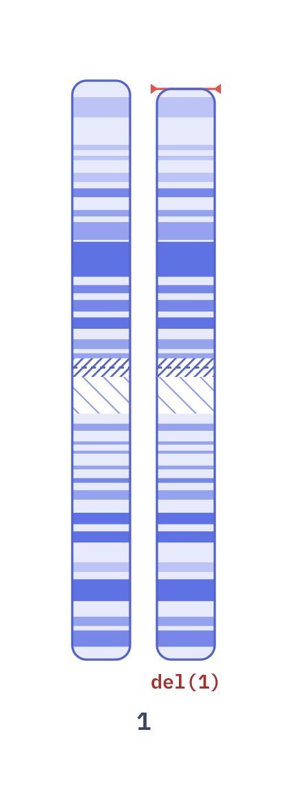 Karyotype of 1p36 deletion syndrome (46,XX,del(1)(p36.3))