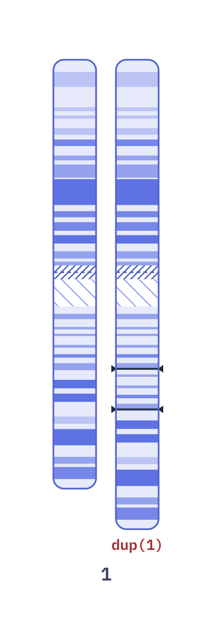 Karyotype of Chromosome 1q duplication (46,XY,dup(1)(q22q25))