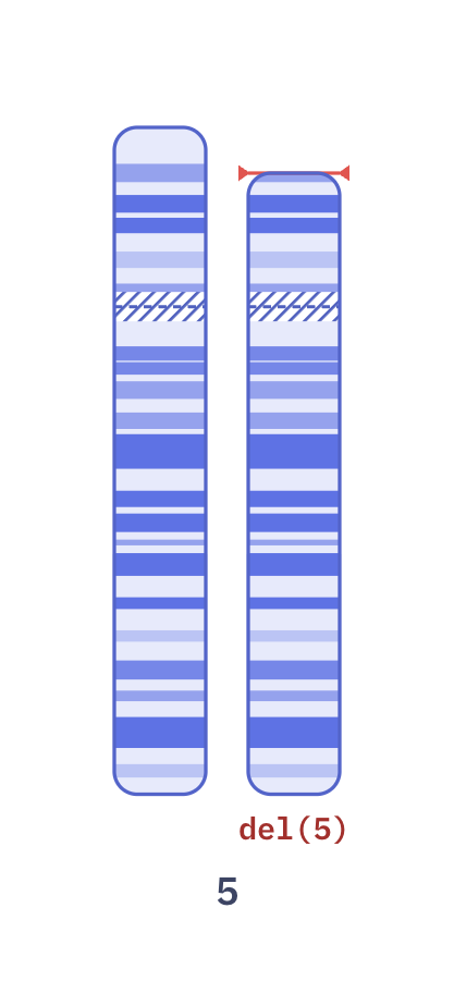 Karyotype of Cri-du-chat syndrome (46,XY,del(5)(p15.2))