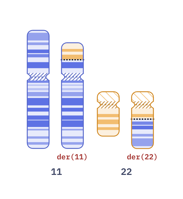 Karyotype of Desmoplastic small round cell tumor t(11;22) (46,XX,t(11;22)(p13;q12))