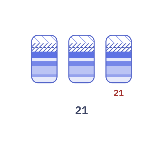 Karyotype of Down syndrome (47,XX,+21)