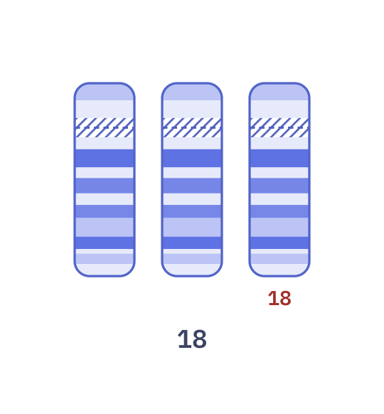 Karyotype of Edwards syndrome (47,XY,+18)