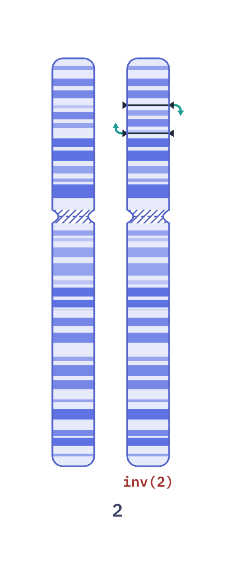 Karyotype of EML4-ALK lung cancer inv(2) (46,XY,inv(2)(p21p23))