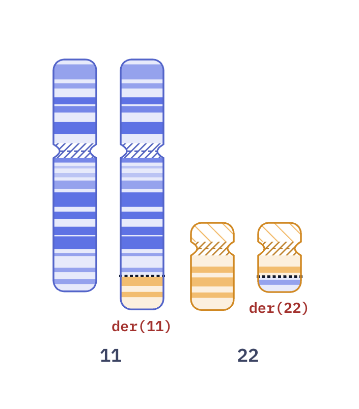 Karyotype of Ewing sarcoma t(11;22) (46,XY,t(11;22)(q24;q12))