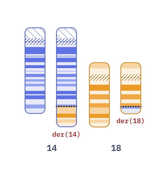 Karyotype of Follicular lymphoma t(14;18) (46,XX,t(14;18)(q32;q21))