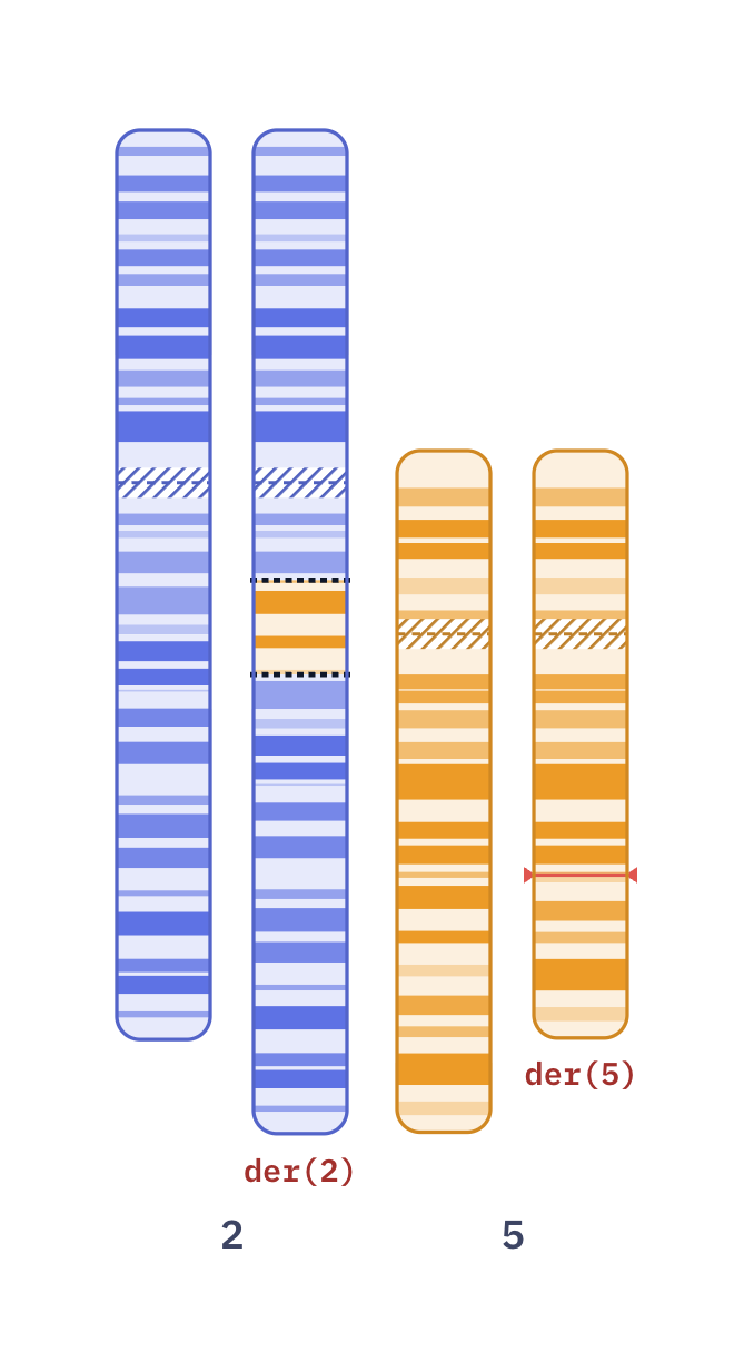 Karyotype of Direct insertion ins(2;5) (46,XY,ins(2;5)(q14.2;q22q31))