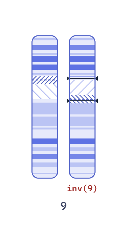Karyotype of Pericentric inversion 9 (46,XY,inv(9)(p11q13))