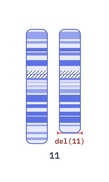 Karyotype of Jacobsen syndrome (46,XY,del(11)(q24.1))