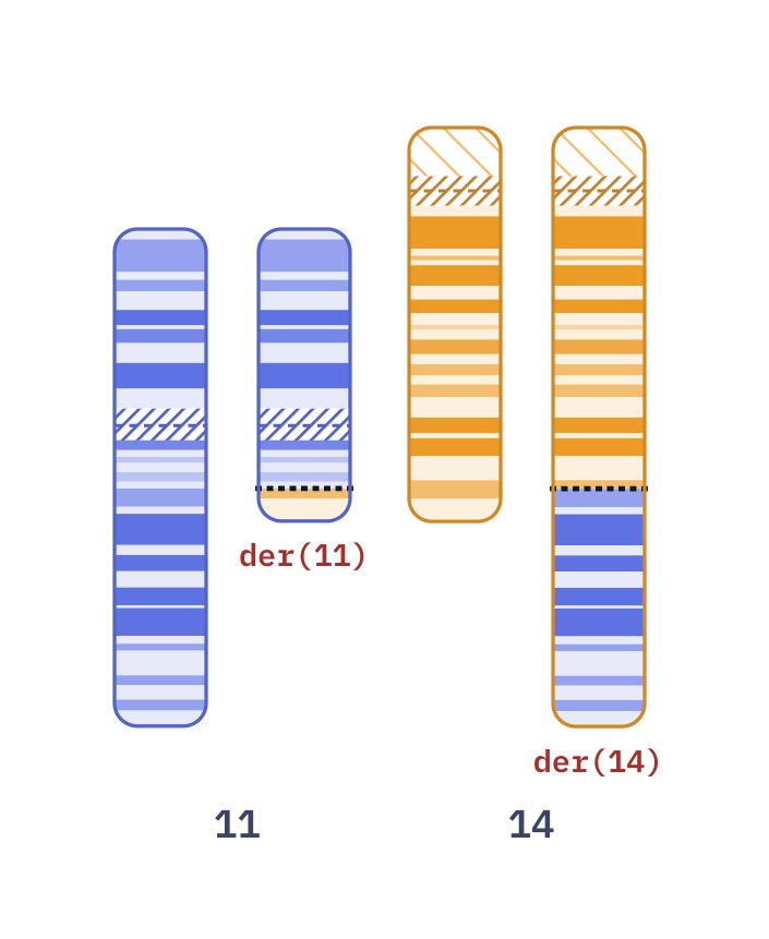 Karyotype of Mantle cell lymphoma t(11;14) (46,XY,t(11;14)(q13;q32))