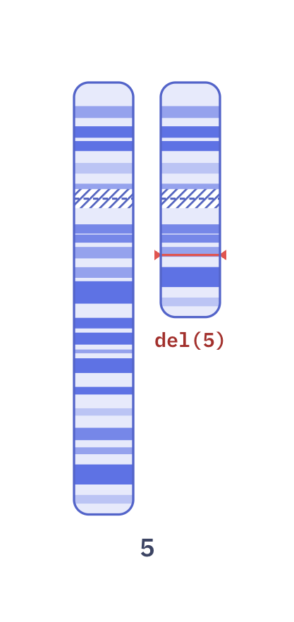 Karyotype of 5q minus syndrome (MDS) (46,XX,del(5)(q13q33))