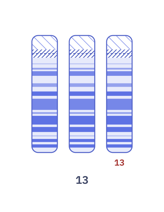Karyotype of Patau syndrome (47,XX,+13)