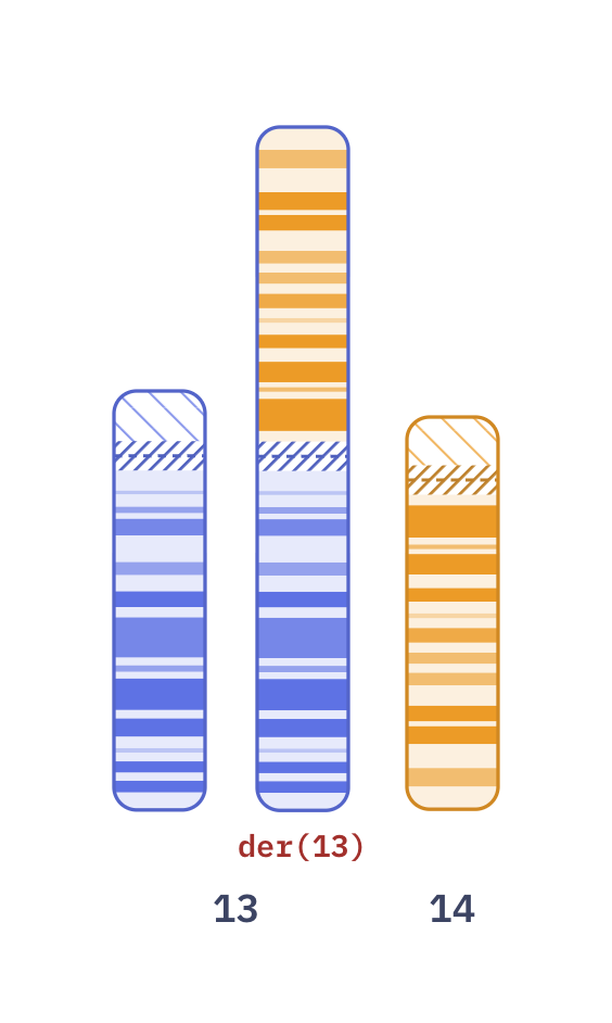 Karyotype of Robertsonian translocation 13;14 (45,XX,rob(13;14)(q10;q10))