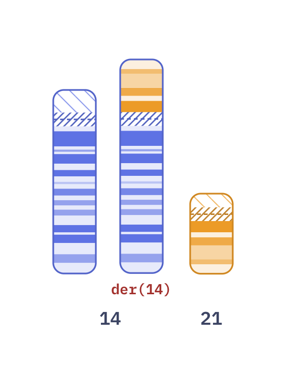 Karyotype of Robertsonian translocation 14;21 (45,XY,rob(14;21)(q10;q10))