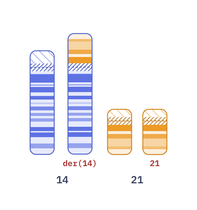 Karyotype of Translocation Down syndrome (46,XX,der(14;21)(q10;q10),+21)