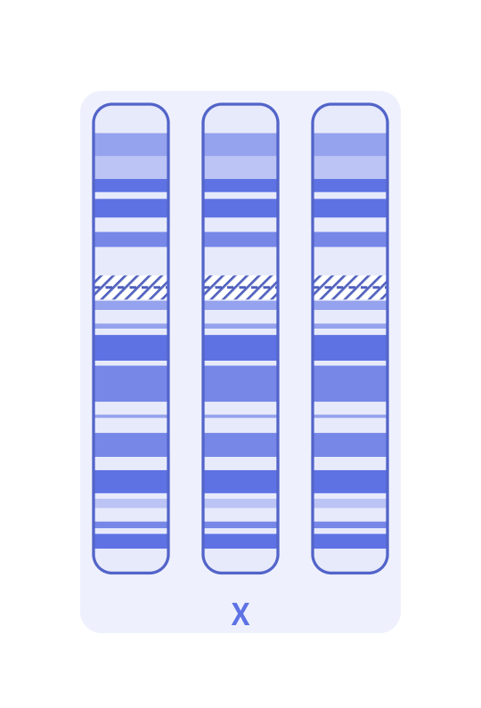 Karyotype of Triple X syndrome (47,XXX)