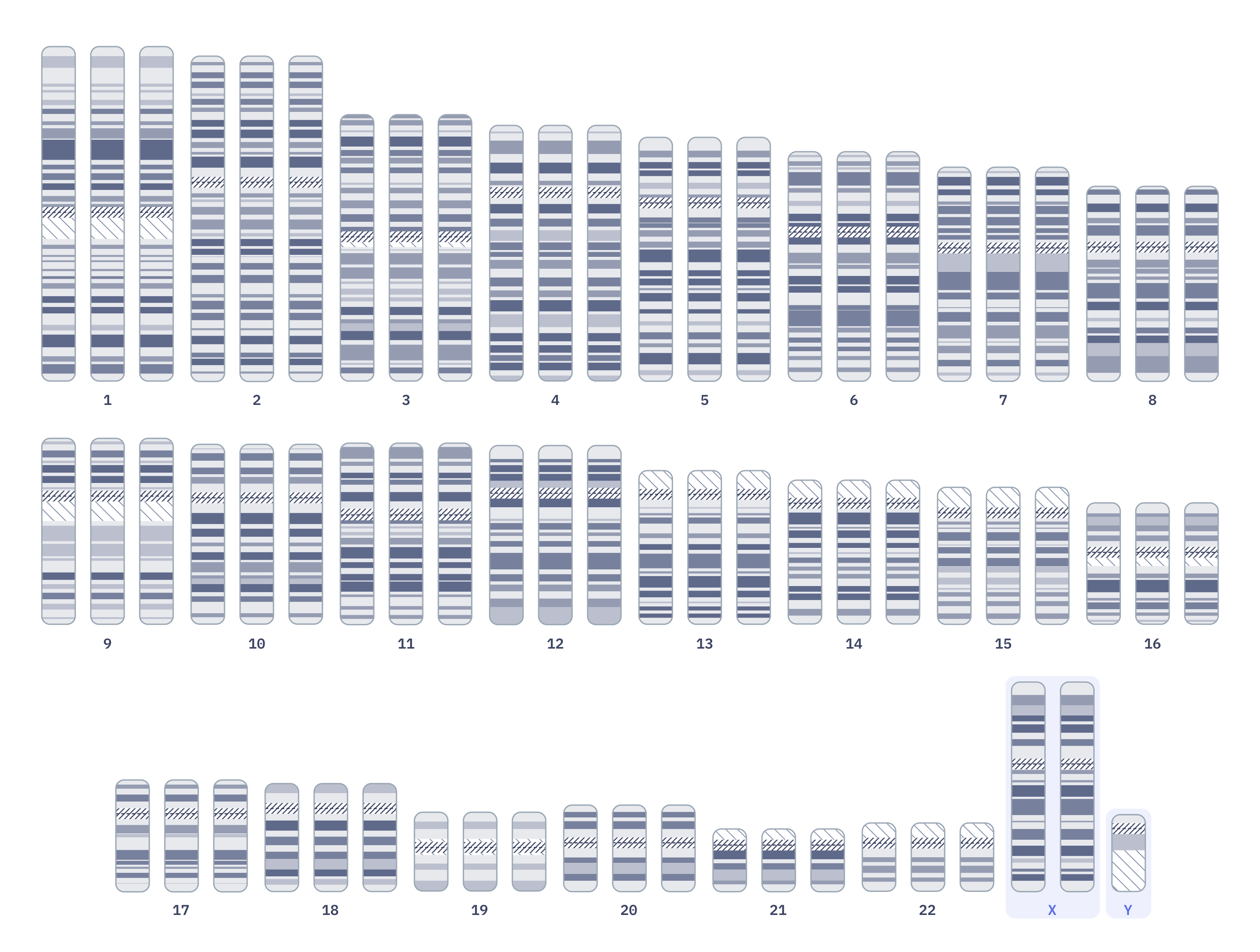 Karyotype of Triploidy (69,XXY)