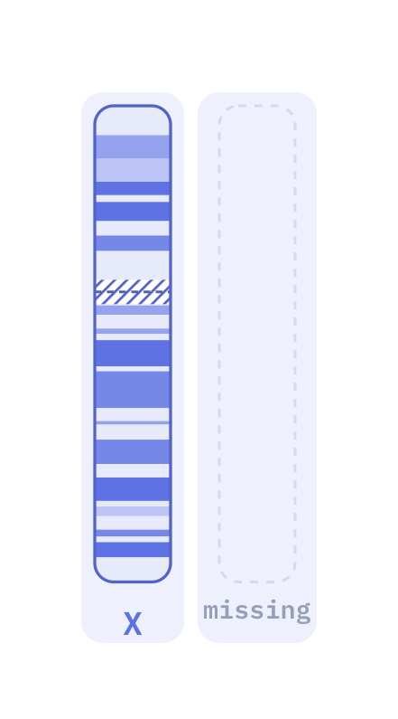 Karyotype of Turner syndrome (45,X)