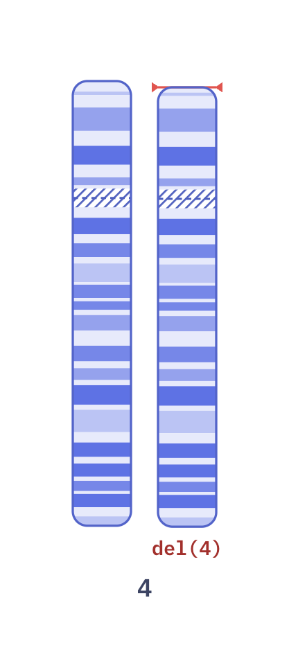 Karyotype of Wolf-Hirschhorn syndrome (46,XX,del(4)(p16.3))